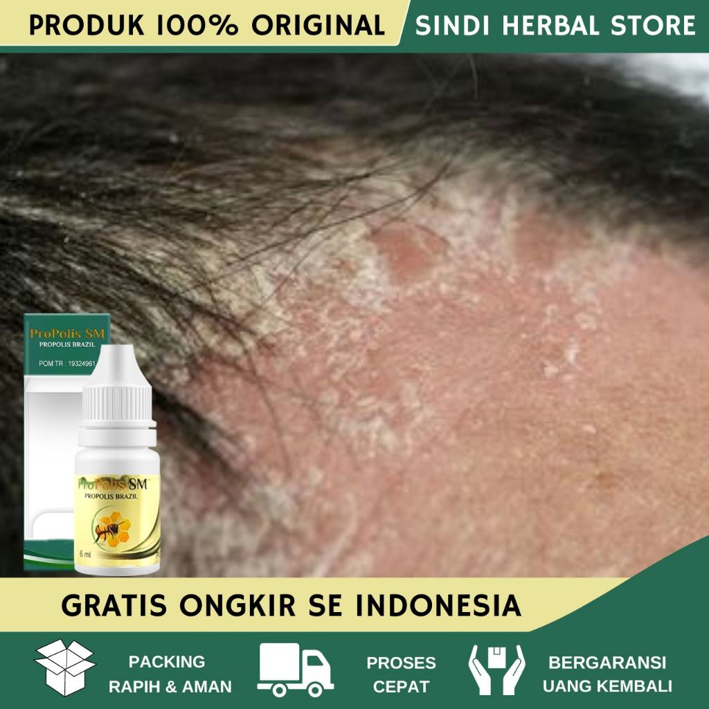 Obat Ketombe Parah, Obat Ketombe Berkerak di Kepala, Obat Ketombe Parah Menahun, Obat Borok Di Kulit