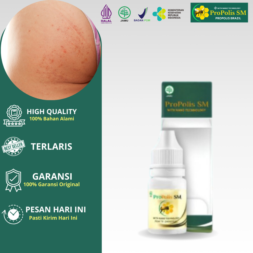ProPolis SM Obat Koreng Di Pantat Pantat Burik Gatal Pantat Bruntusan Obat Jerawat Di Pantat Penghil
