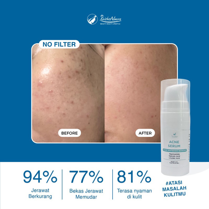 SERUM ACNE - Keisha Almera Skincare