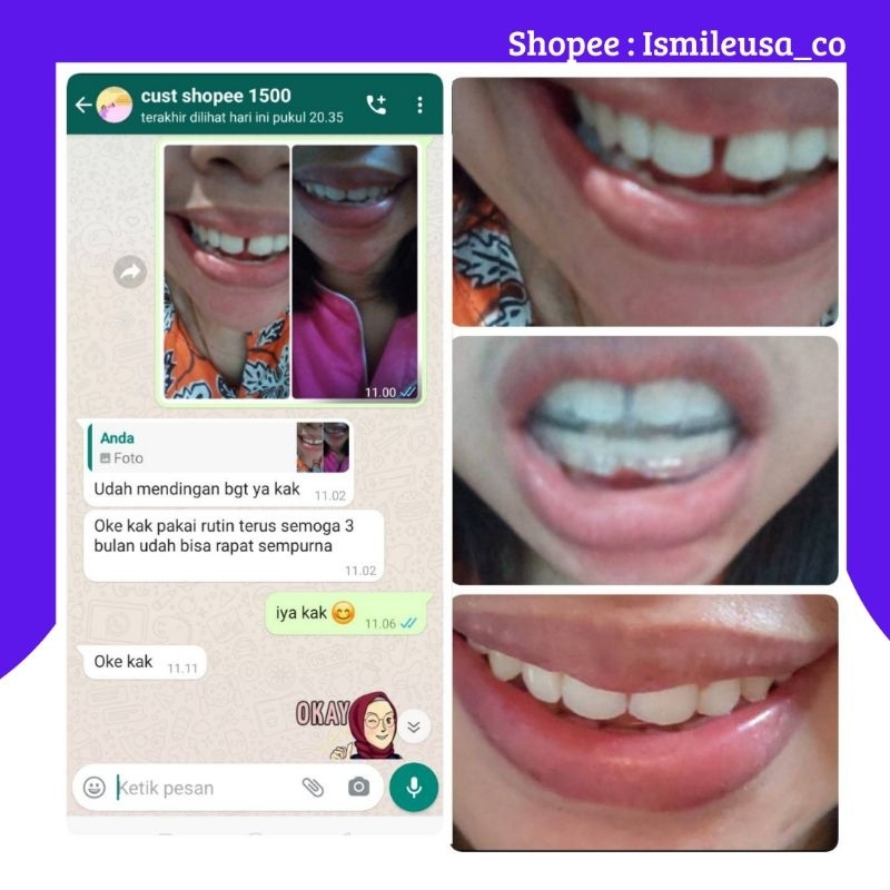 ISMILEUSA/ISMILE USA/PERAPIH GIGI/PERAPIH GIGI ORI USA/SOLUSI GIGI/PERATA GIGI