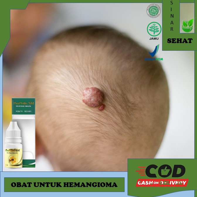 obat hemangioma Obat Herbal Hemangioma Obat Hemangioma, Tumor Hemangioma, Benjolan Kemerahan Pada Ba