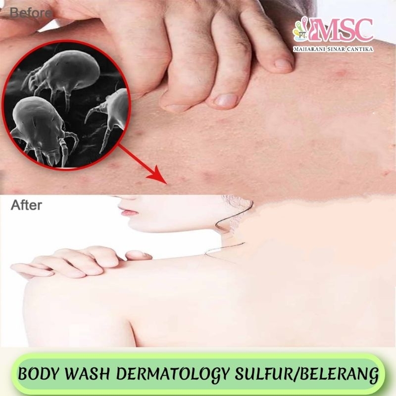 SABUN MANDI CAIR DERMATOLOGY SULFUR 5 LITER