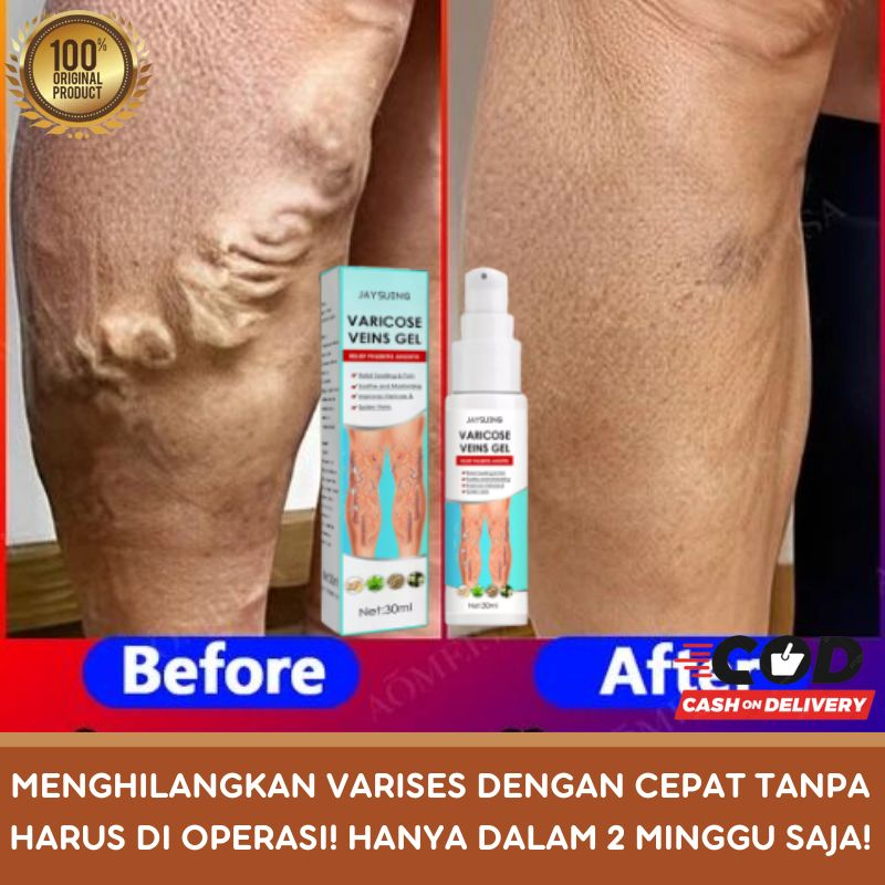 Spray Semprotan Varises Varicose Veins Obat Varises Paling Ampuh