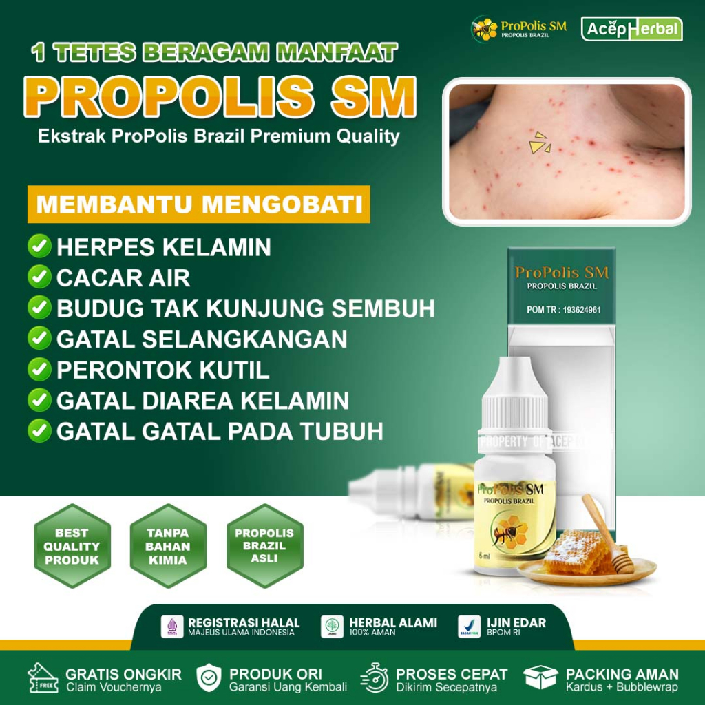 Obat Cacar Air & Bekas Cacar Gatal Berair Cacar Api Cacar Ayam Salep Cacar Anak Dewasa Penghilang Be