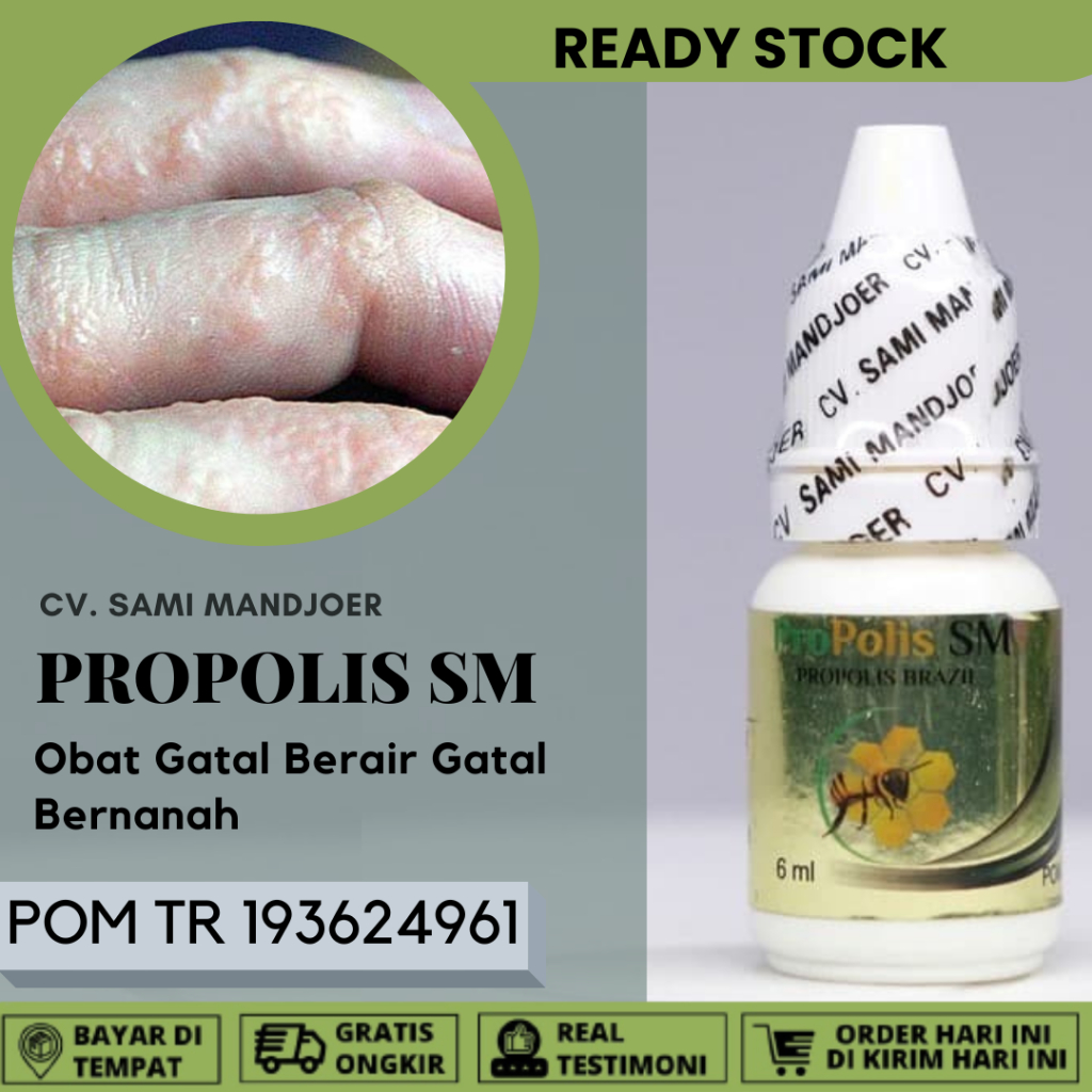 Obat Gatal Berair Di Jari Tangan Obat Gatal Bernanah, Obat Kutu Air, Gatal Berair Menyebar, Cenang D