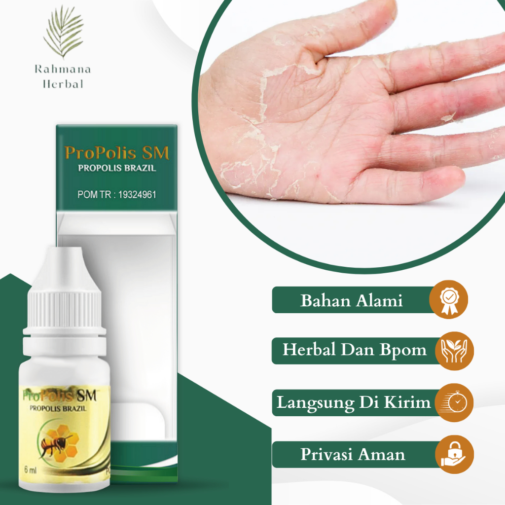 Obat Jari Tangan Kering, Obat Jari Tangan Mengelupas, Obat Jari Tangan Kasar, Obat Telapak Tangan Ga