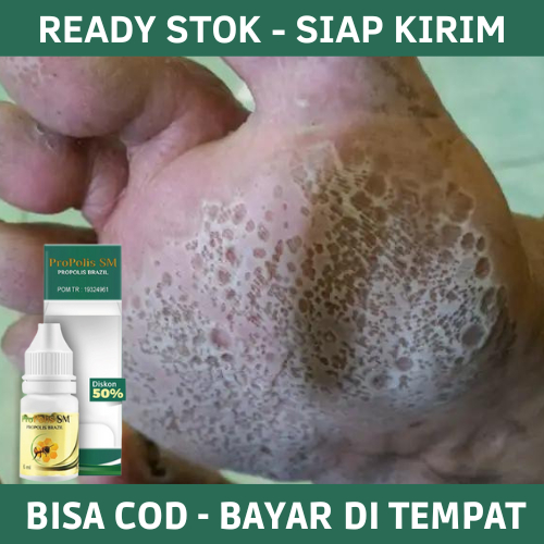 Obat Kaki Rayapan, Obat Kaki Rayapan dan Bau, Obat Kaki Rayapan Berlubang, Obat Kaki Kapalan, Obat P