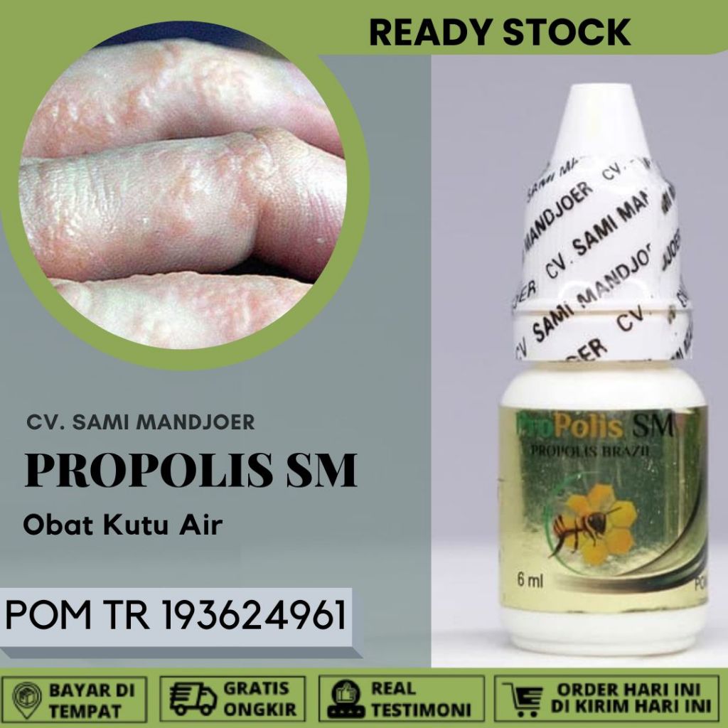 Obat Kutu Air Penghilang Kutu Air di Kaki dan Tangan, Obat Gatal Berair, Jamur kaki, Gatal Kaki, Kum
