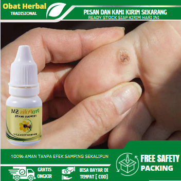 Obat Mata Ikan Telapak kaki, Obat Perontok Mata Ikan, Mata Ikan di Telapak Kaki/Tangan, Obat Kapalan