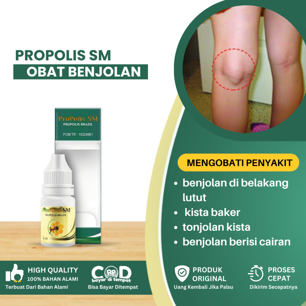 Obat Benjolan Di Belakang Lutut, Obat Penghilang Benjolan Di Lutut, Obat Kista Baker, Lutut Kiri Kan