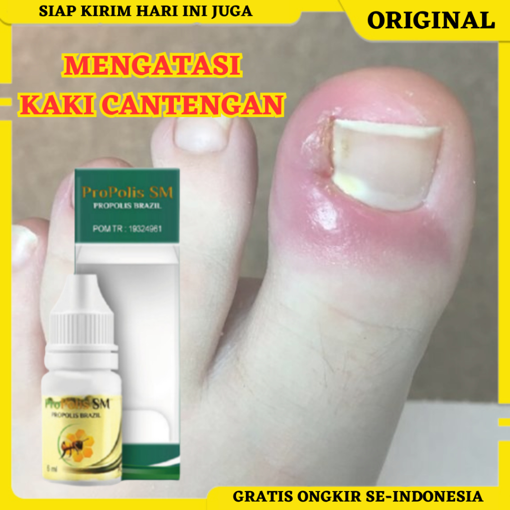 Propolis SM, Obat Tetes Cantengan, Obat Cantengan Jempol Kaki/Tangan, Obat Cantengan Bernanah, Obat 