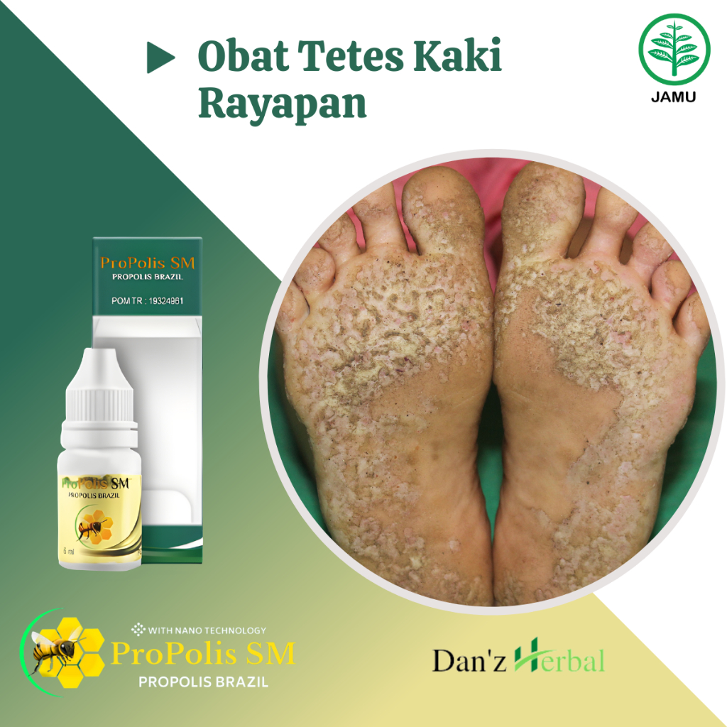 Obat Kaki Rayapan Obat Penghilang Rayapan Kaki Telapak Kaki Bolong Bolong Tumit Pecah Pecah Obat Kak