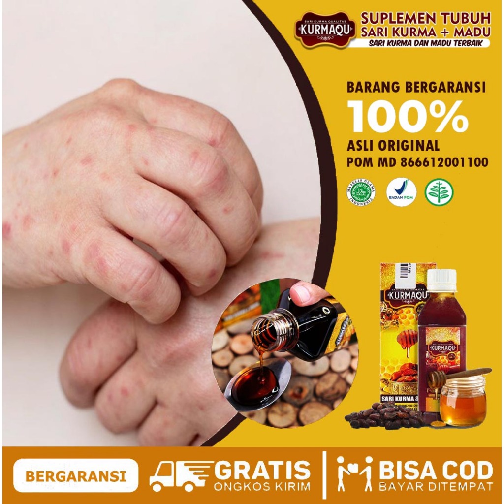 Obat Darah Manis Herbal , Gatal Darah Manis, Gatal Gatal Seluruh Badan, Gatal Ruam  Kemerahan Akibat