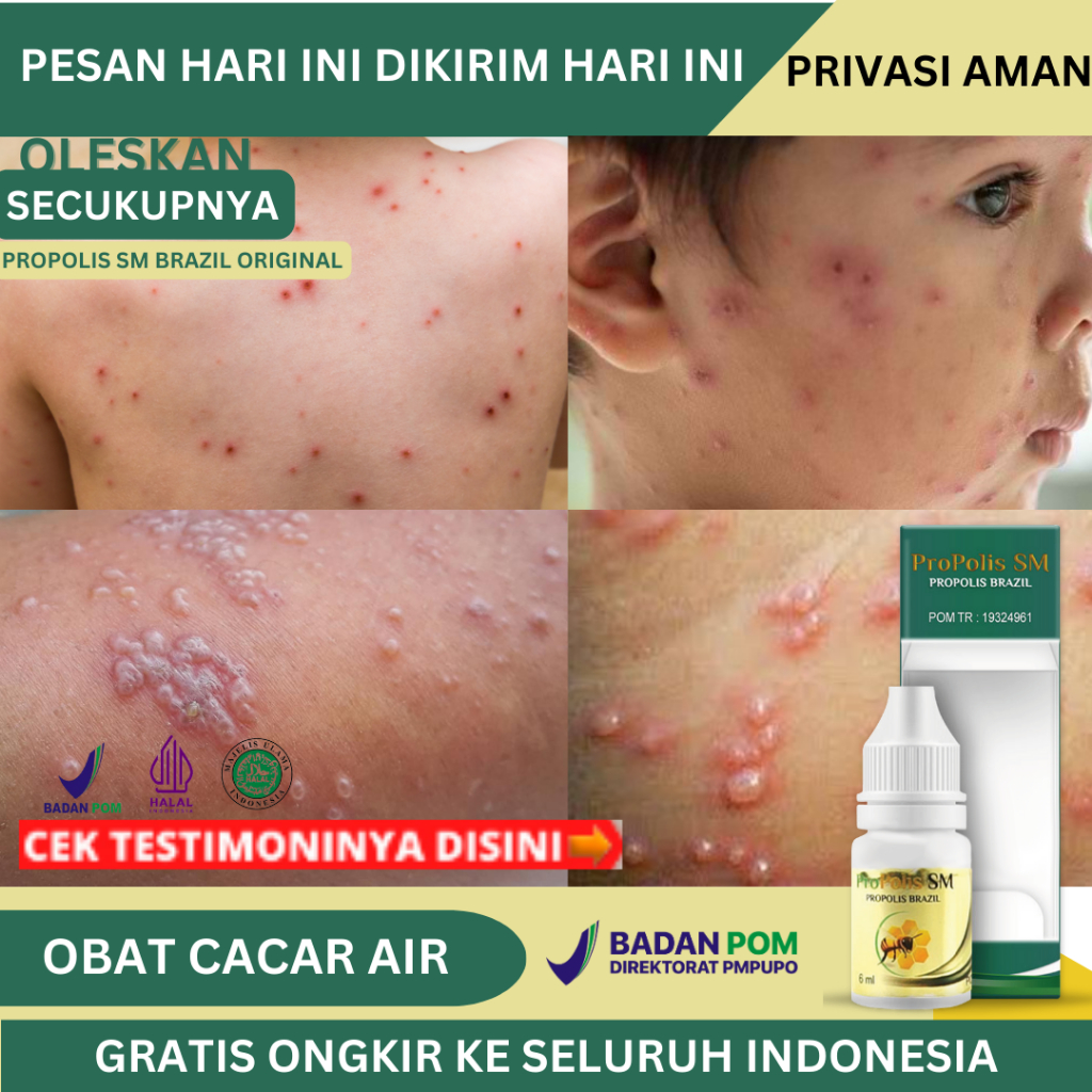 Obat Cacar Air, Obat Penghilang Bekas Cacar, Obat Cacar Api, Obat Campak, Obat Cacar Air Untuk Anak 