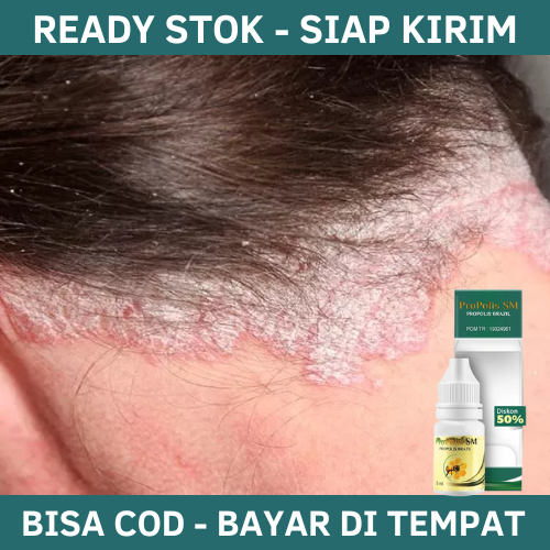 Obat Psoriasis Kulit Kepala, Obat Psoriasis Kulit Kepala, Obat Gatal Kulit Kepala, Obat Kulit Kepala