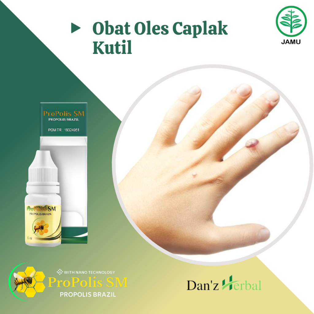 Obat Caplak Kutil, Obat Kutil di Jari Tangan, Obat Penghilang Kutil di Leher, Obat Menghilangkan Kut