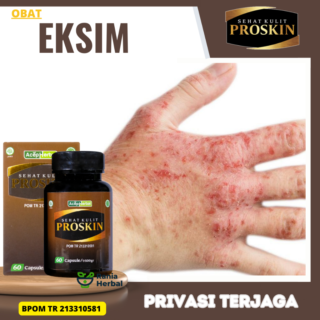 Obat Eksim, Obat Eksim Kering, Obat Eksim Basah, Obat Eksim Anak, Obat Eksim Dewasa, Obat Untuk Meng
