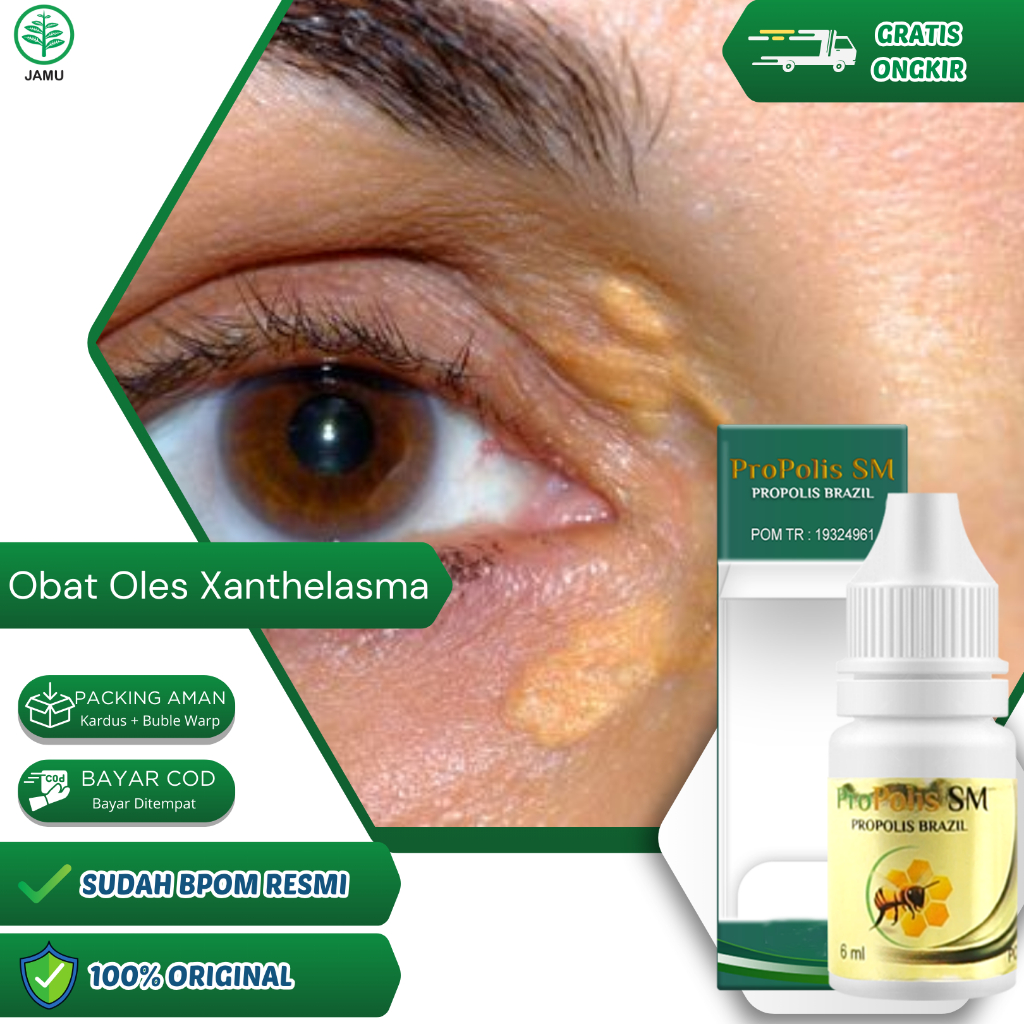 Propolis SM 6ml - obat salep xanthelasma hilangkan lemak mata karena xanthelasma