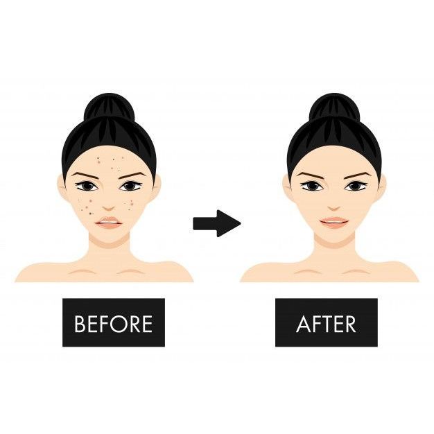 Serum Tranex kusam flek melasma bekas jerawat merah atau hitam