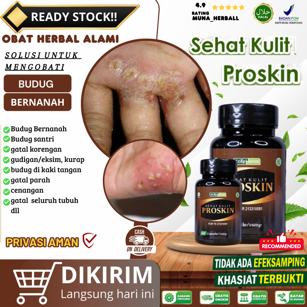 Obat Budugan, Obat Budug Bernanah, Gatal Bernanah, Obat Korengan, Obat Korengan Bernanah, Obat Gudik