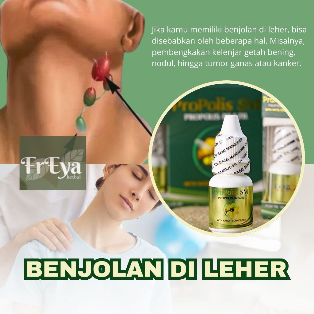 Obat Benjolan Di Leher Kelenjar Getah Bening Tumor Jinak