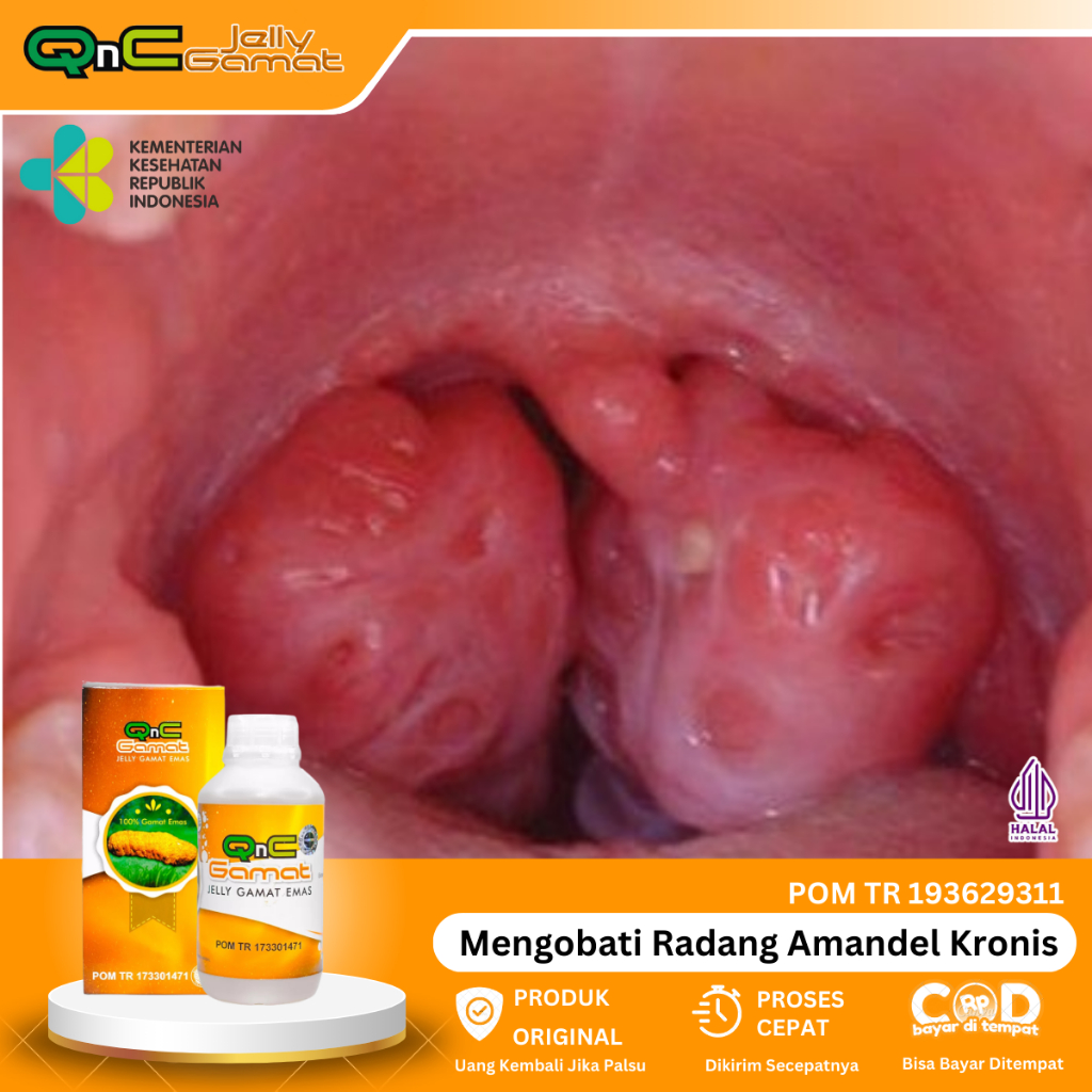 Qnc Jelly Gamat - Amandel, Penghancur Amandel, Infeksi Amandel, Nyeri Saat Menelan, Amandel Bengkak,