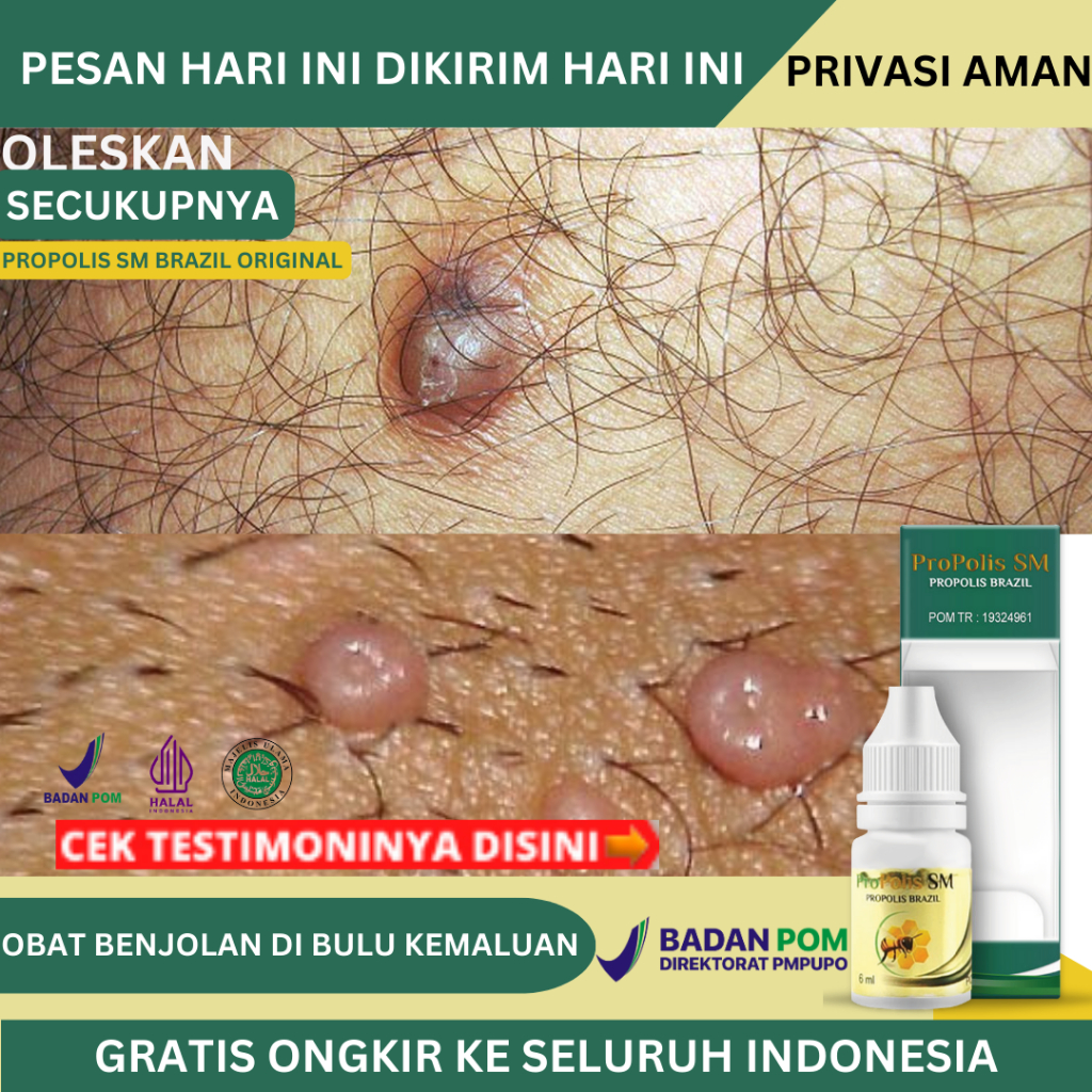 Obat Benjolan Di Bulu Kemaluan, Obat Benjolan Di Kelamin Pria & Wanita, Obat Bintik Gatal Di Kemalua