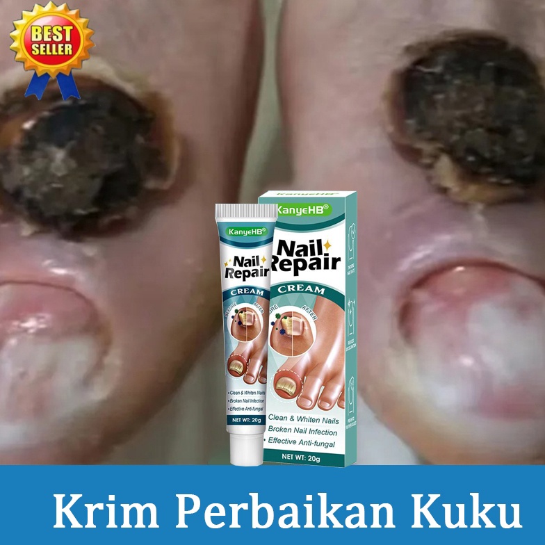 ART A97C Obat Jamur Kuku obat kuku jamur dan rusak obat jamur kuku lanbena 2g Obat cantengan obat Ku