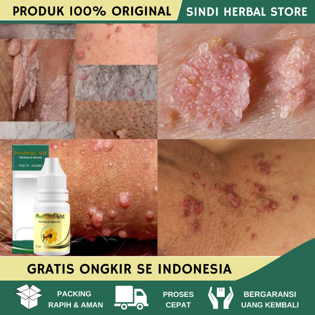Obat Perontok Kutil Kelamin Jengger Ayam HPV