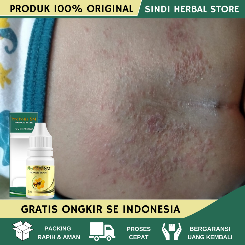 Obat Gatal Pantat, Obat Gatal dan Hitam di Pantat, Obat Pantat Burik, Obat Gatal Pantat Anak dan Dew