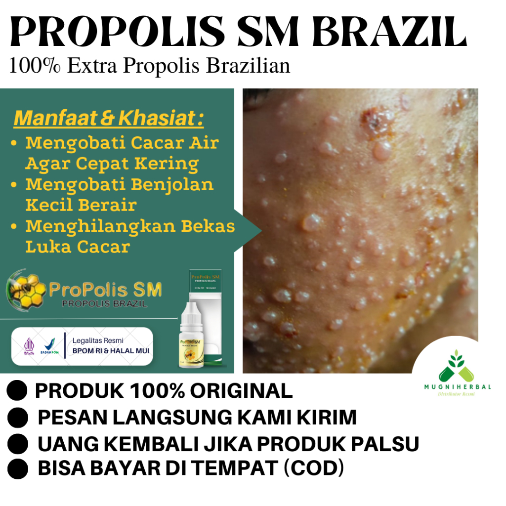 Propolis SM - Obat Cacar Air, Cacar Api, Cacar Monyet, Penghilang Bekas Luka Cacar, Cacar Bernanah, 