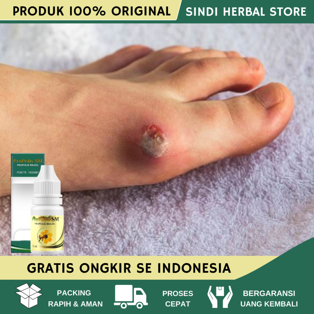 Obat Luka Diabetes, Obat Pengering Luka Gangren Diabetes Melitus, Obat Luka Diabetes Agar Cepat Keri