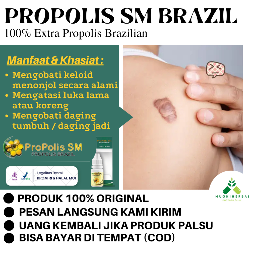 Propolis SM - Obat Keloid Menonjol Tahunan, Daging Tumbuh Di Kulit, Keloid Bekas Luka, Keloid Daging