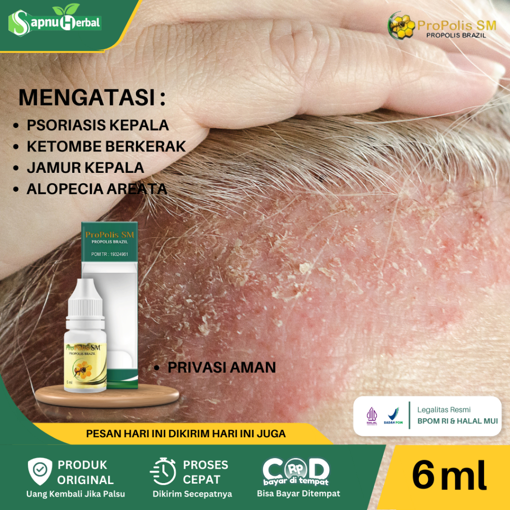 Propolis SM Obat Psoriasis Gatal Kulit Psoriasis Obat Kulit Bersisik Di Siku Tangan Lutut Kulit Bers