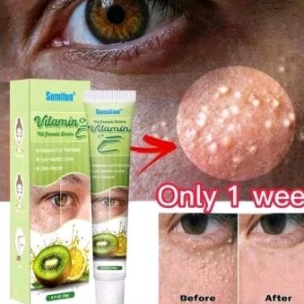 Cream mata milea mengobati milea bintik bintik bawah mata