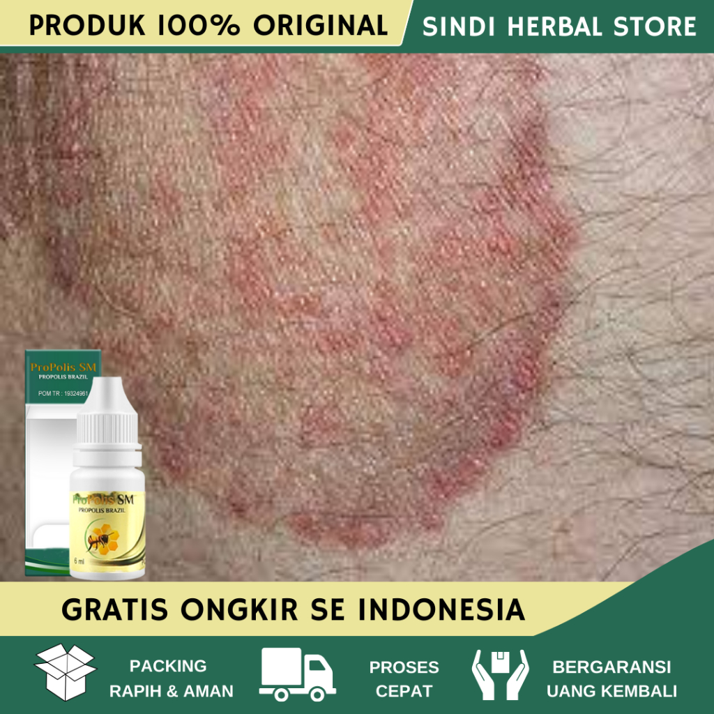 Obat Gatal Selangkangan Obat Gatal Di Selangkangan Masalah Kulit Pria Wanita Obat Kurap Selangkangan