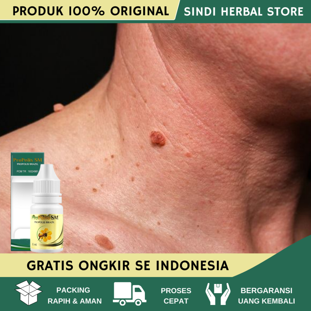 Obat Kutil di Leher, Obat Perontok Kutil Di Leher, Obat Kutil, Obat Penghilang Skin Tag, Obat Papilo