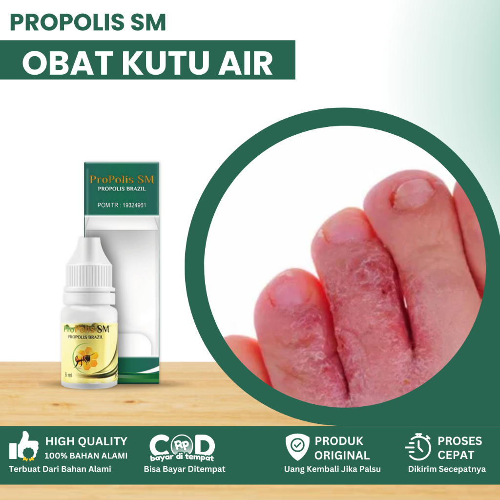Obat Kutu Air, Obat Kutu Air Pada Kaki, Obat Penghilang Kuman Air, Obat Kutu Air Pada Sela Jari Kaki