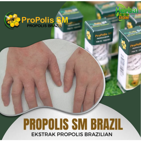 Obat Penghilang bruntusan di tangan tidak gatal, kulit bruntusan di badan, obat bruntusan di tangan 