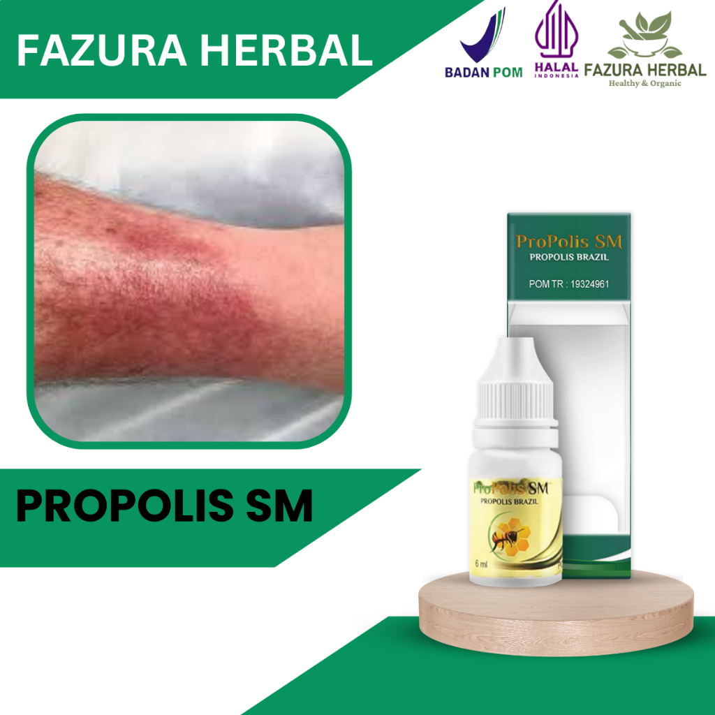 Propolis SM - Obat Selulitis, Obat Infeksi Bakteri Pada Kulit, Obat Peradangan Pada Kulit