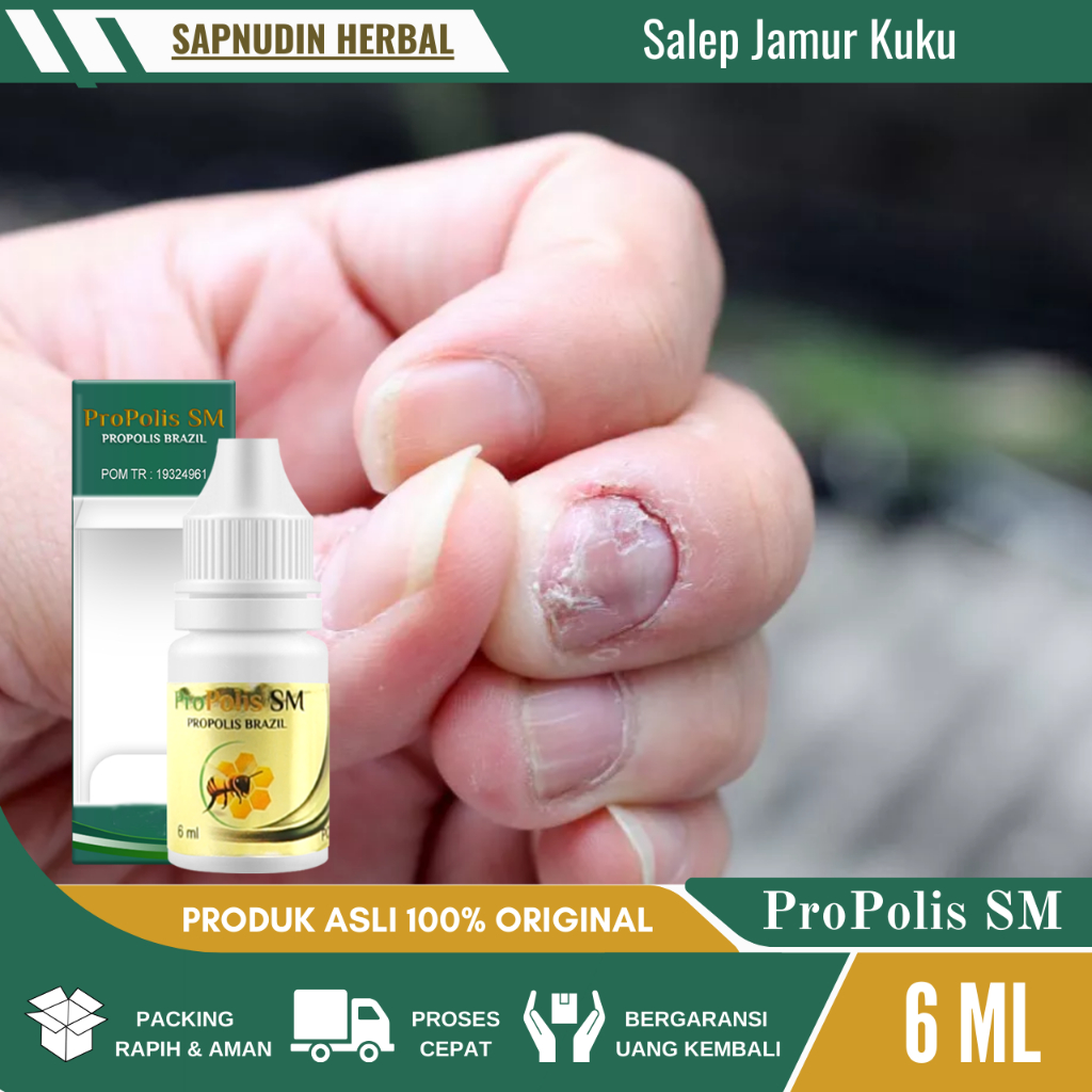 Salep Tetes Jamur Kuku, Salep kuku Jamuran, Salep  Jamur Kuku Tangan Agar Cepat Sembuh, Salep Jamur 