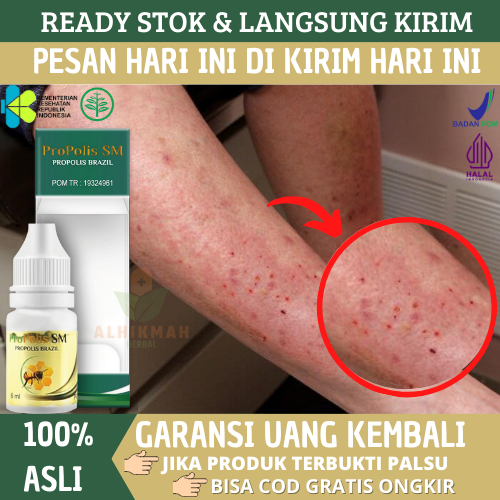 Obat Gatal Kulit Karena Alergi Semen, Obat Gatal Dermatitis Kontak, Gatal Atopik Seboroik, Obat Gata