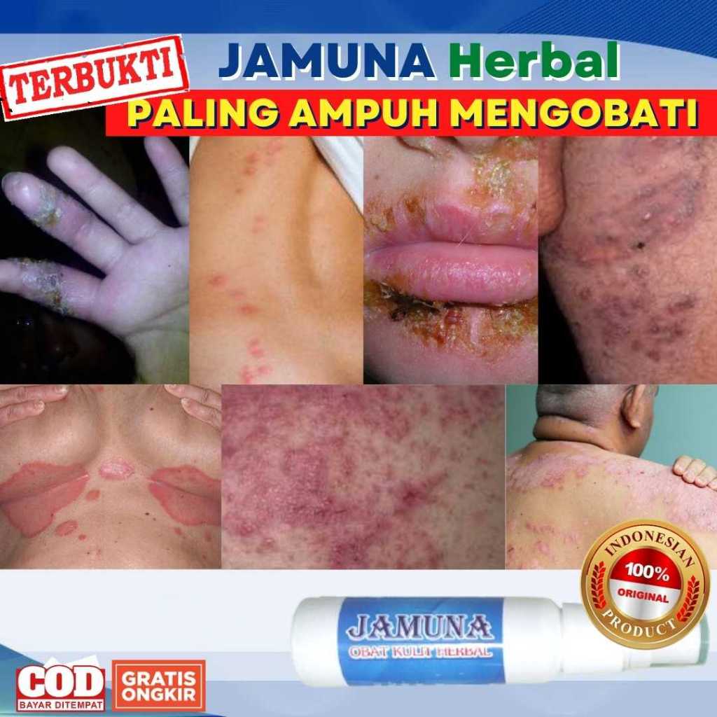 JAMUNA Herbal Obat Gatal Selangkangan Eksim dan Jamur Paling Ampuh Aman Untuk Semua Jenis Kulit 25ml