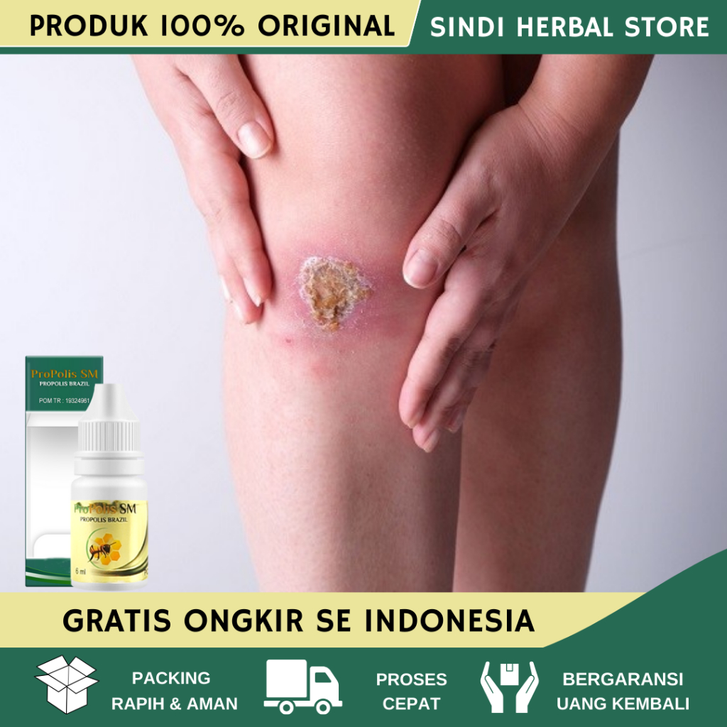 Obat Salep Pengering Luka Diabetes - Obat Luka Diabetes - Obat Luka Diabetes Agar Cepat Kering - Oba