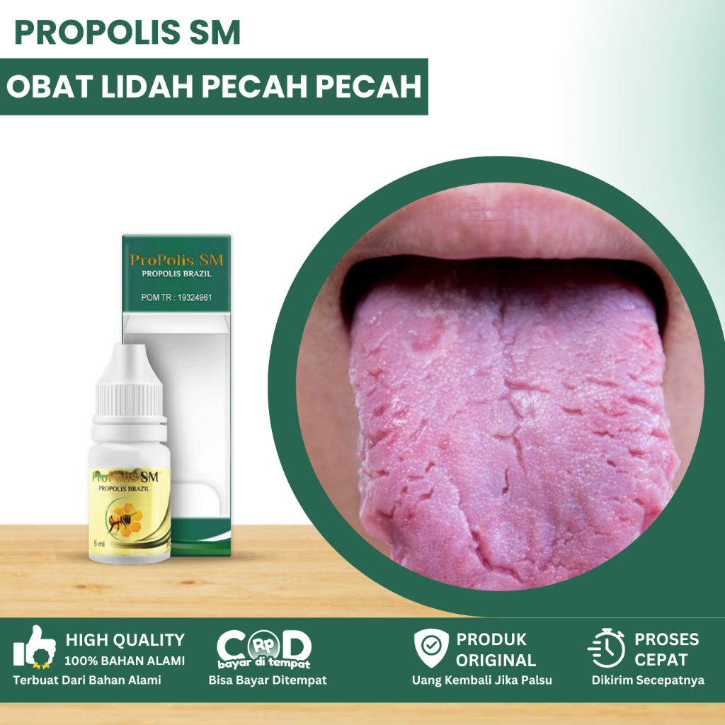 Obat Lidah Pecah Pecah, Obat Lidah Sariawan, Obat Lidah Putih Berjamur, Bercak Putih Di Lidah, Obat 