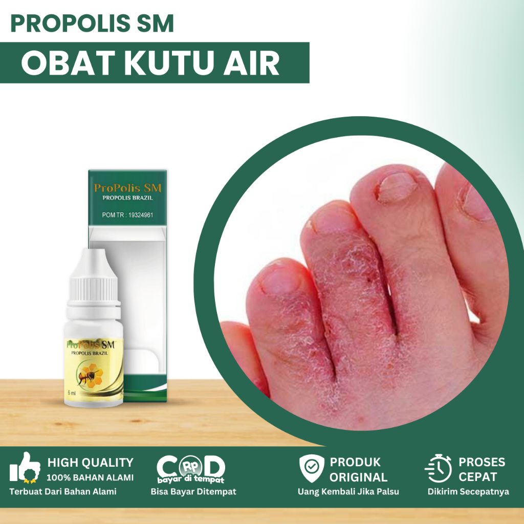 Obat Kutu Air Pada Kaki, Obat Penghilang Kuman Air, Obat Kutu Air Ruam Dan Gatal,Obat Jamur Kutu Air