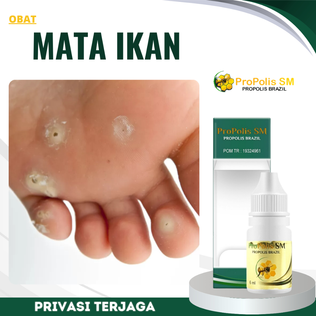 Obat Mata Ikan, Obat Penghilang Mata Ikan, Obat Perontok Mata Ikan di Telapak Kaki & Tangan, Salep M