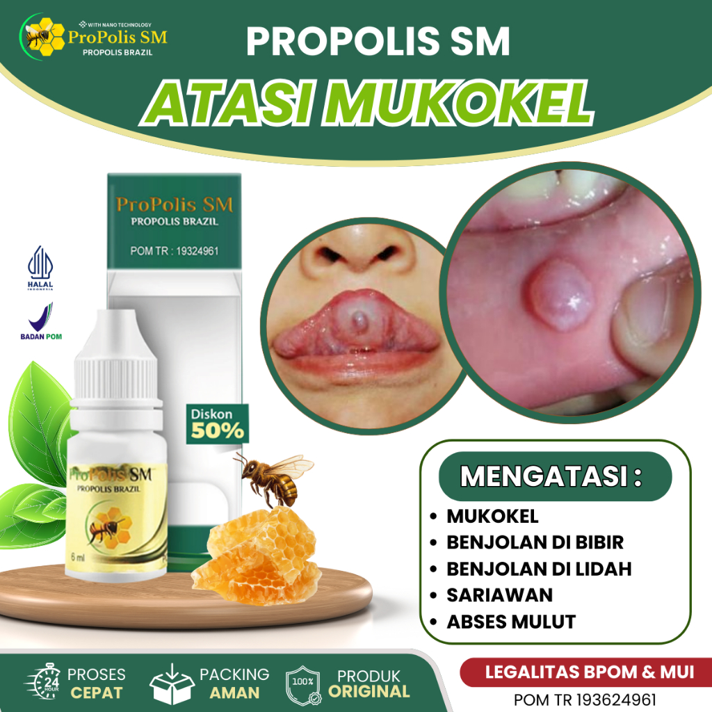 Obat Mukokel, Obat Benjolan Di Bibir, Obat Benjolan Di Lidah, Obat Gusi Bengkak, Obat Bengkak Kelenj