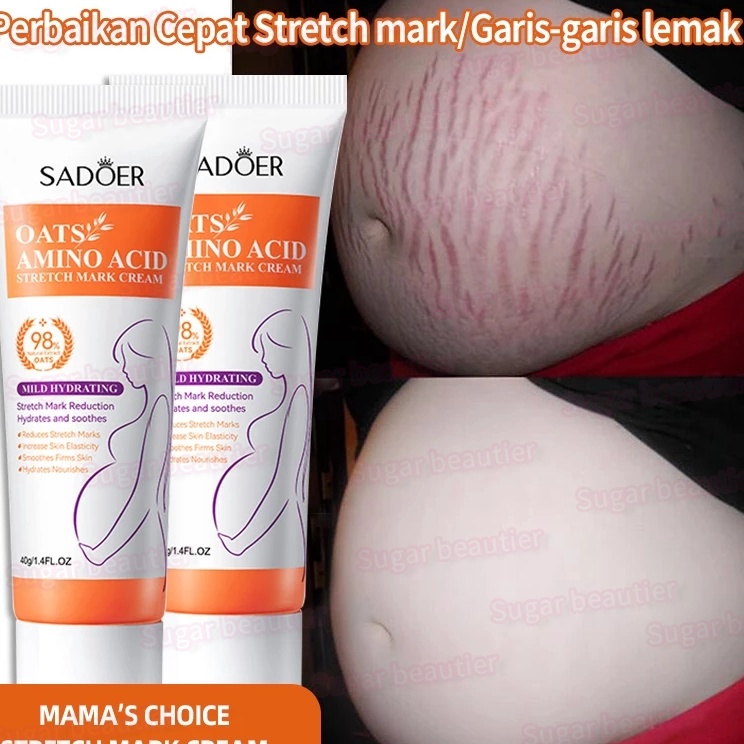 Essential Krim Penghilang Stretch Mark Krim Stretch Mark Ori Stretch Mark Cream Penghilang Luka Krim