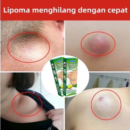 SUMIFUN LIPOMA CREAM SALEP HERBAL